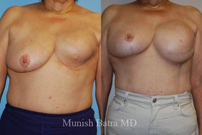 Breast Cancer Reconstruction Before & After Gallery - Patient 419922 - Image 1