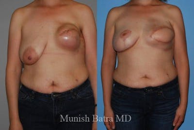 Breast Cancer Reconstruction Before & After Gallery - Patient 309881 - Image 1