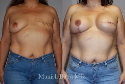Breast Cancer Reconstruction Before & After Gallery - Patient 269682 - Image 1