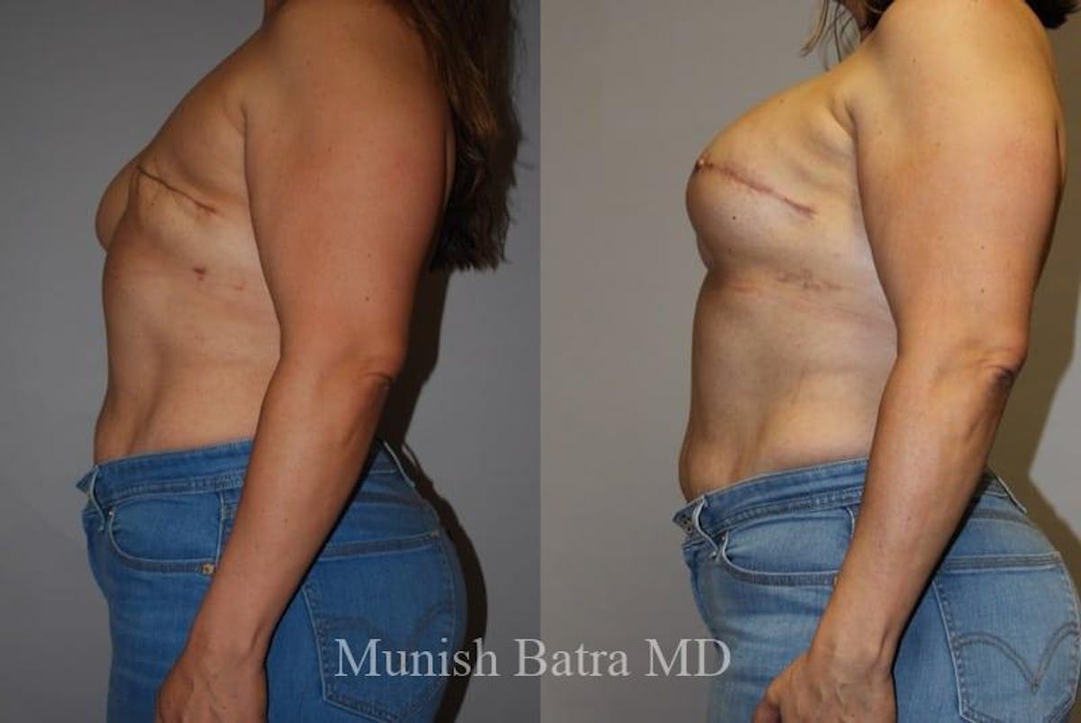 Breast Cancer Reconstruction Before & After Gallery - Patient 269682 - Image 2