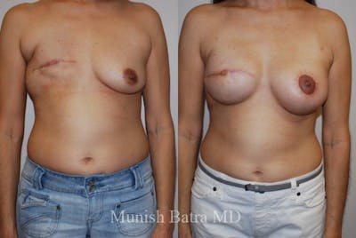 Breast Cancer Reconstruction Before & After Gallery - Patient 325945 - Image 1