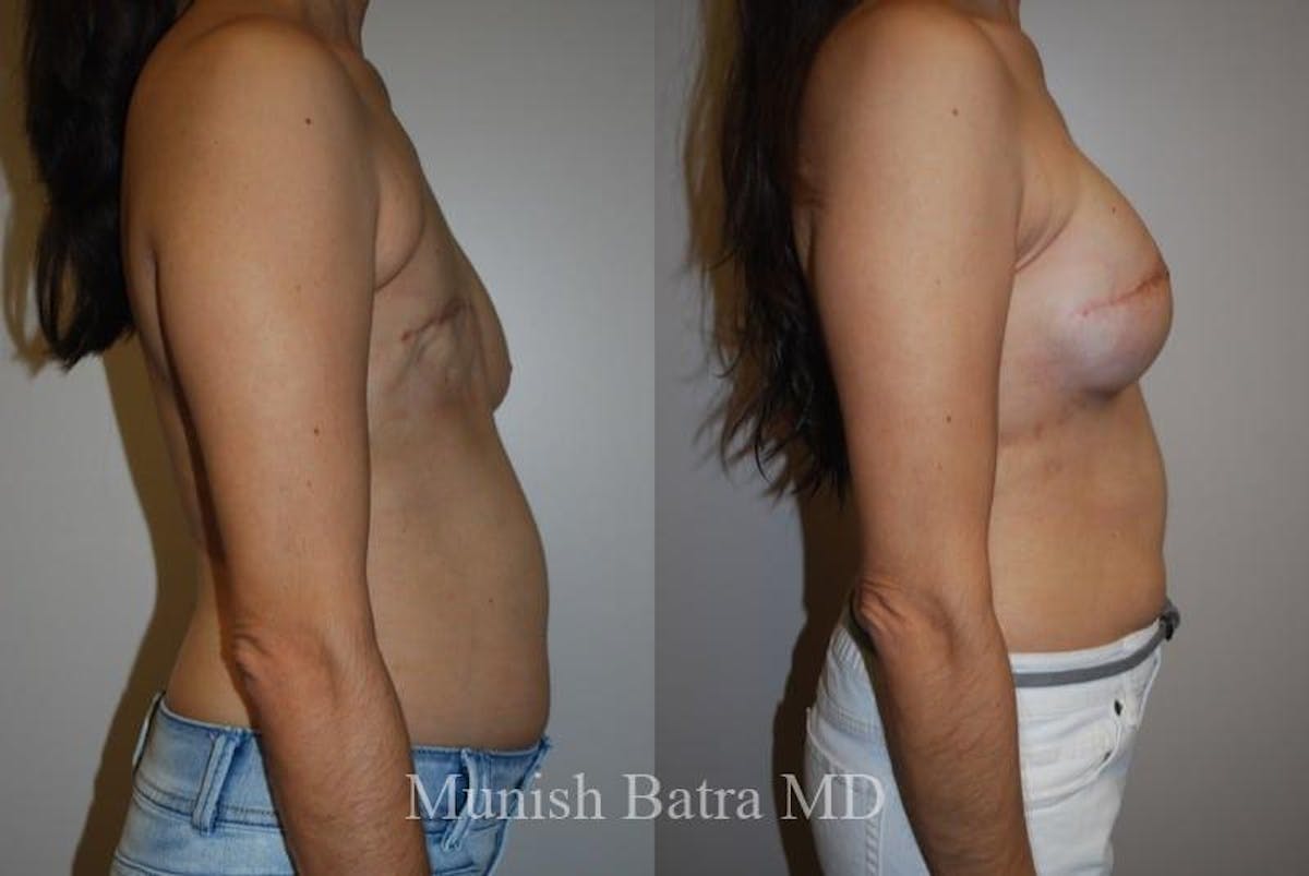 Breast Cancer Reconstruction Before & After Gallery - Patient 325945 - Image 2