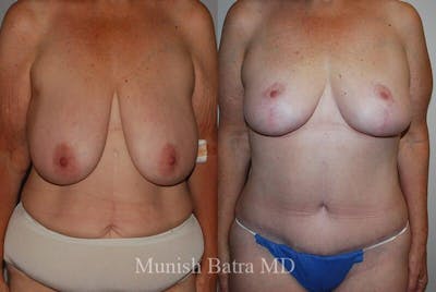 Breast Lift Before & After Gallery - Patient 120571 - Image 1