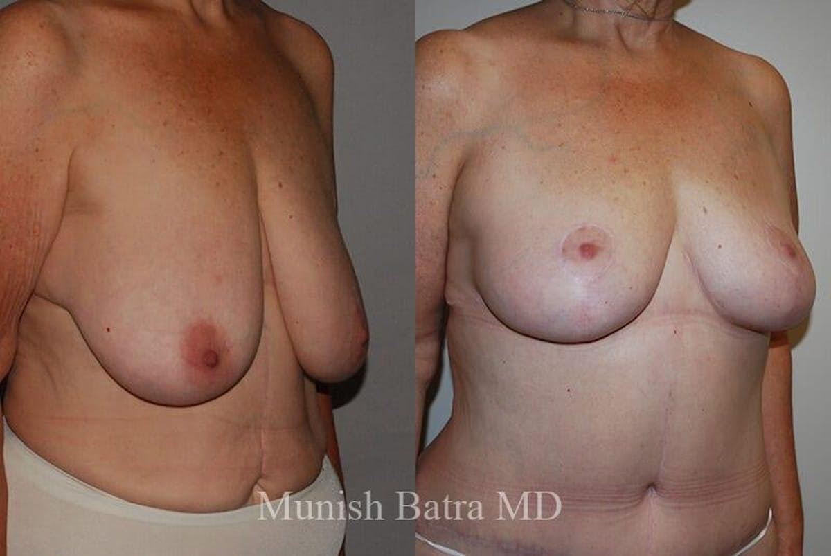 Breast Lift Before & After Gallery - Patient 120571 - Image 2