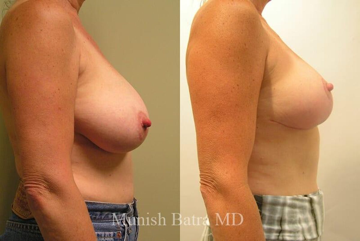 Breast Lift Before & After Gallery - Patient 349005 - Image 2
