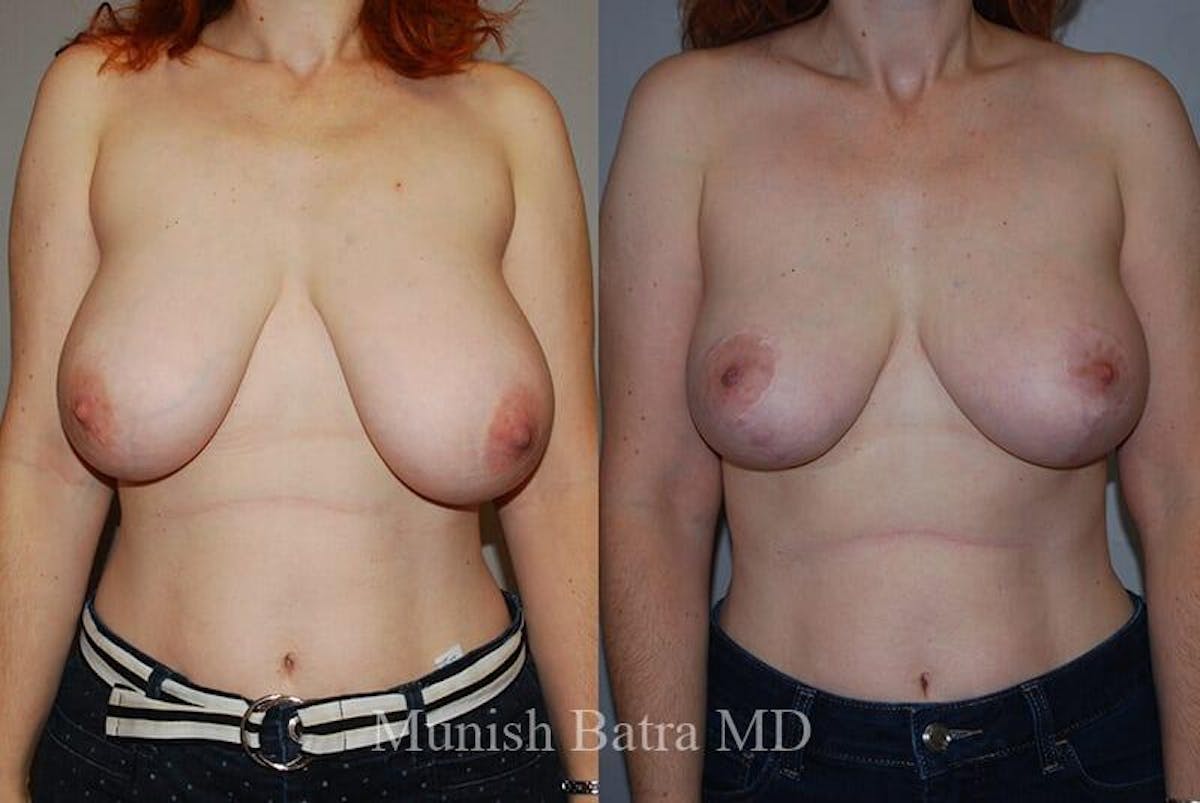 Breast Lift Before & After Gallery - Patient 114211 - Image 1