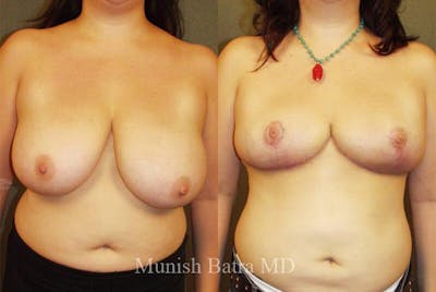 Breast Lift Before & After Gallery - Patient 346485 - Image 1