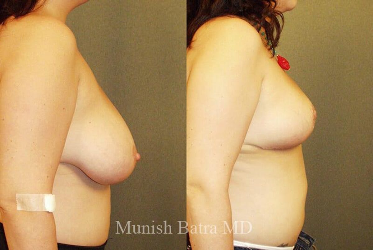Breast Lift Before & After Gallery - Patient 346485 - Image 2