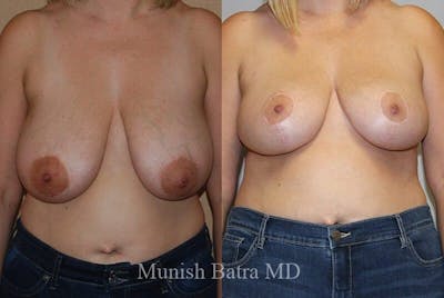 Breast Lift Before & After Gallery - Patient 126387 - Image 1