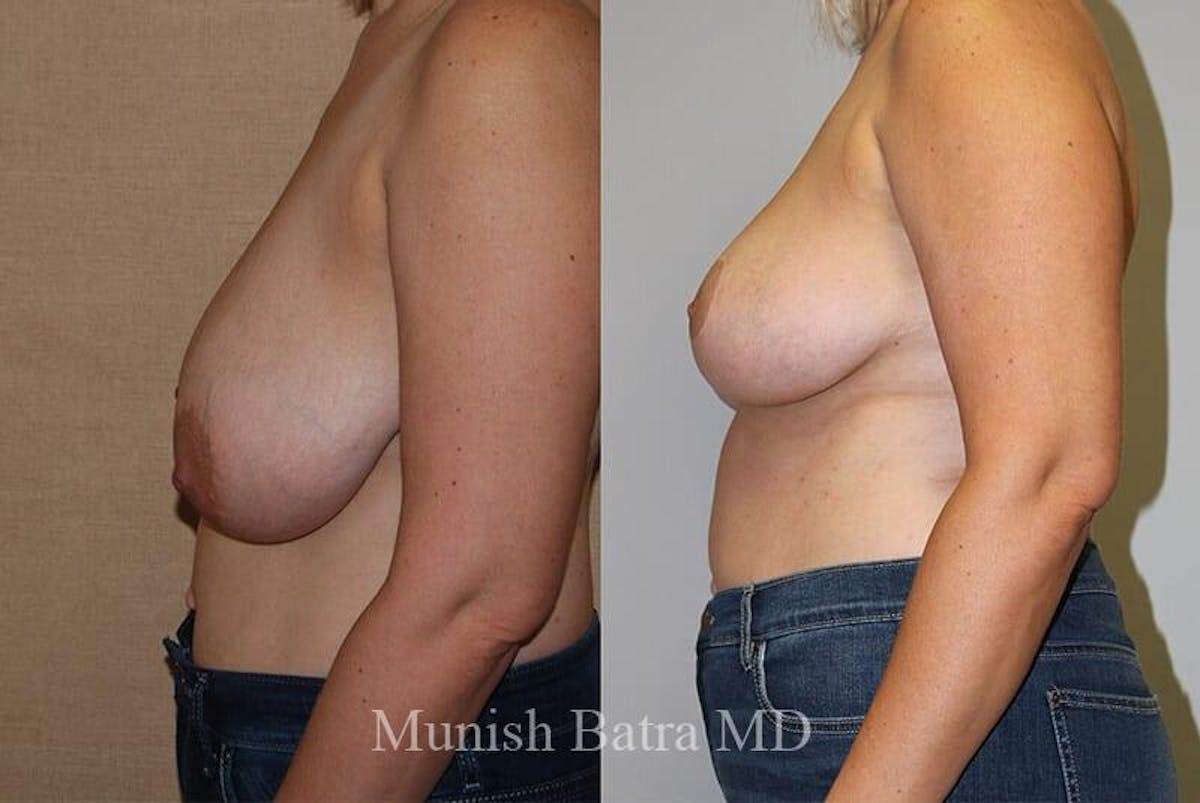 Breast Lift Before & After Gallery - Patient 126387 - Image 2