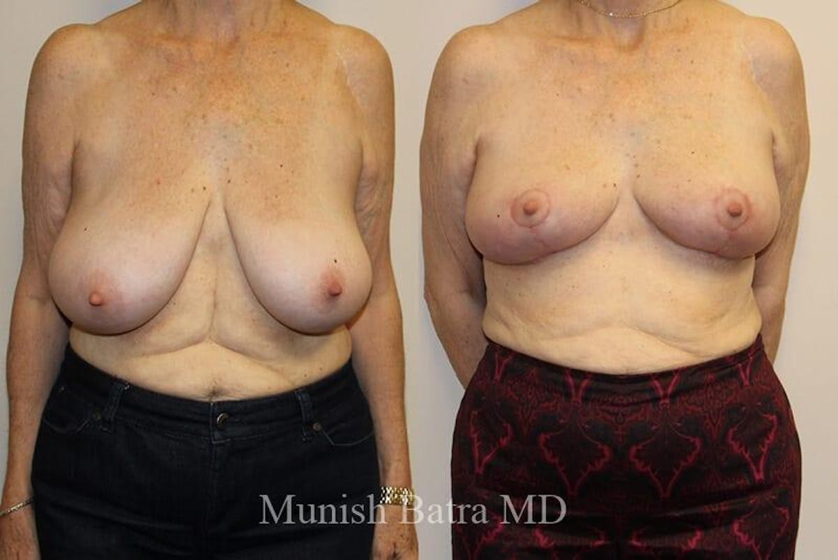 Breast Lift Before & After Gallery - Patient 428606 - Image 1