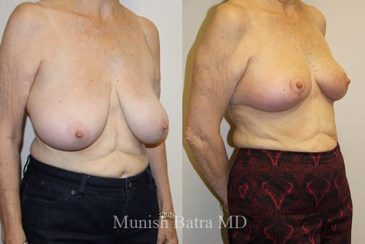 Breast Lift Before & After Gallery - Patient 428606 - Image 2