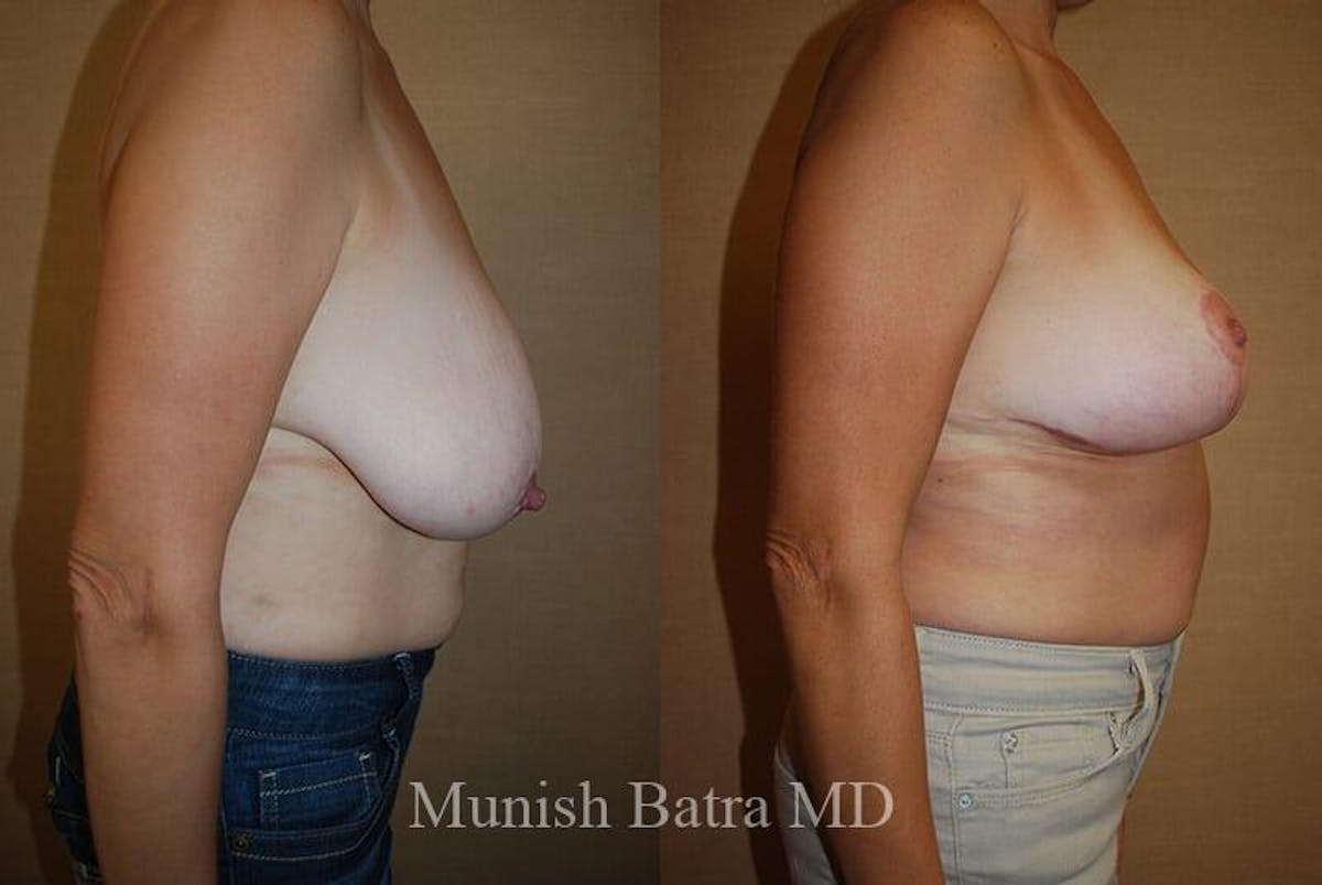 Breast Lift Before & After Gallery - Patient 414678 - Image 2
