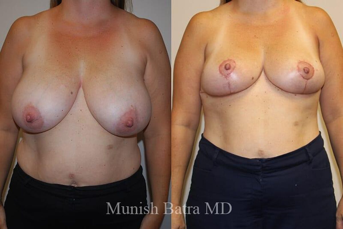 Breast Lift Before & After Gallery - Patient 383848 - Image 1