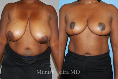 Breast Lift Before & After Gallery - Patient 391133 - Image 1