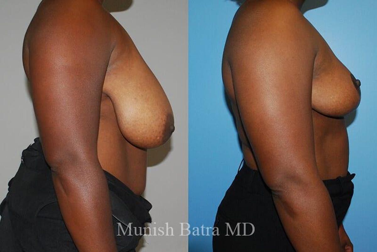 Breast Lift Before & After Gallery - Patient 391133 - Image 2