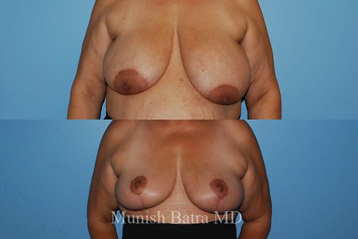 Breast Lift Before & After Gallery - Patient 248561 - Image 1