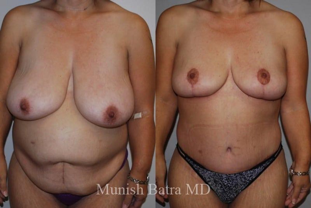 Breast Lift – Reduction Before & After Gallery - Patient 342795 - Image 1