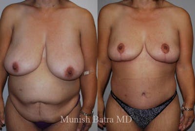 Breast Lift – Reduction Before & After Gallery - Patient 342795 - Image 1