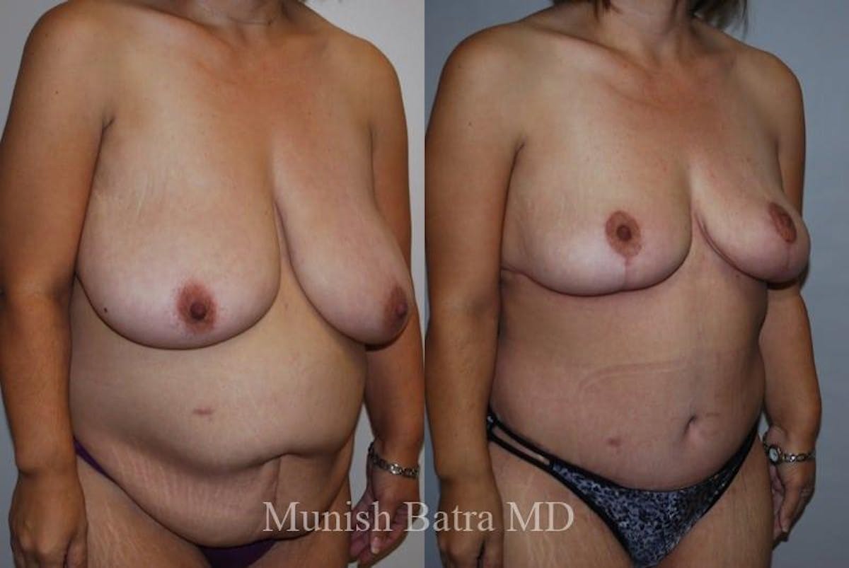 Breast Lift – Reduction Before & After Gallery - Patient 342795 - Image 2