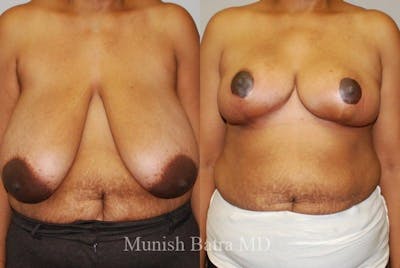 Breast Lift – Reduction Before & After Gallery - Patient 343030 - Image 1