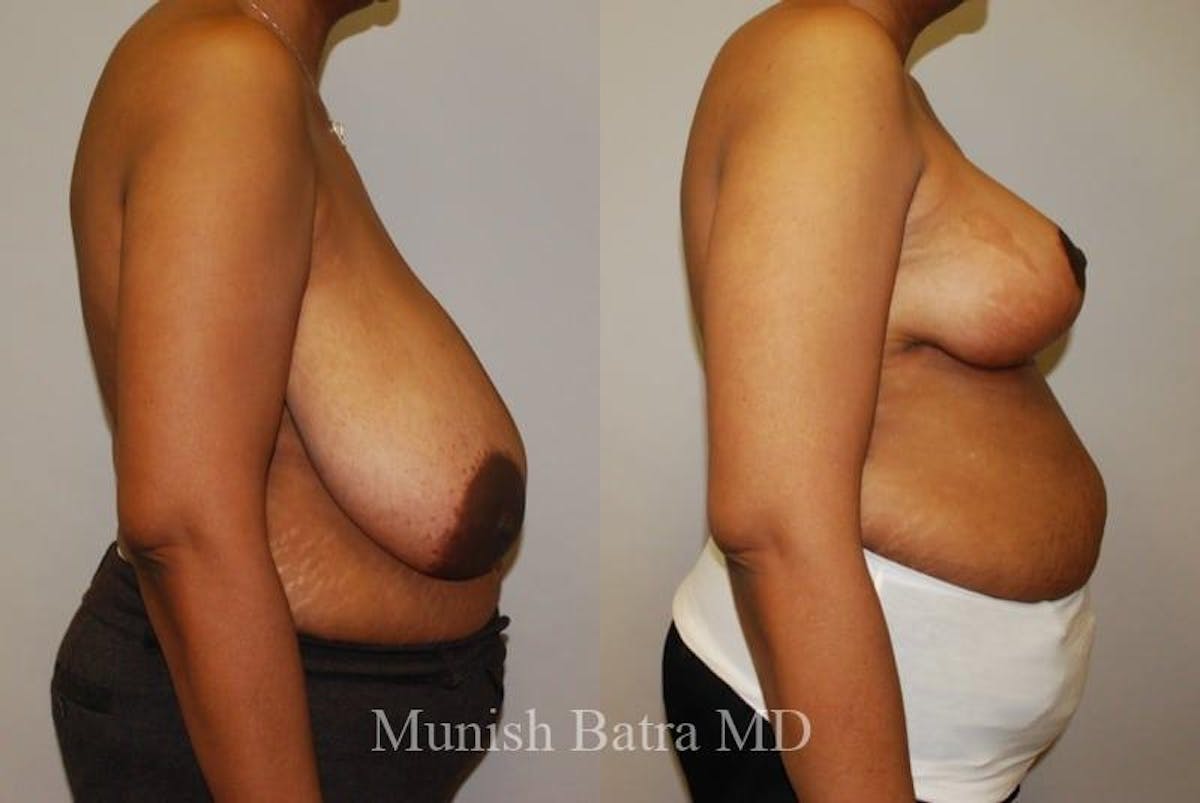 Breast Lift – Reduction Before & After Gallery - Patient 343030 - Image 2