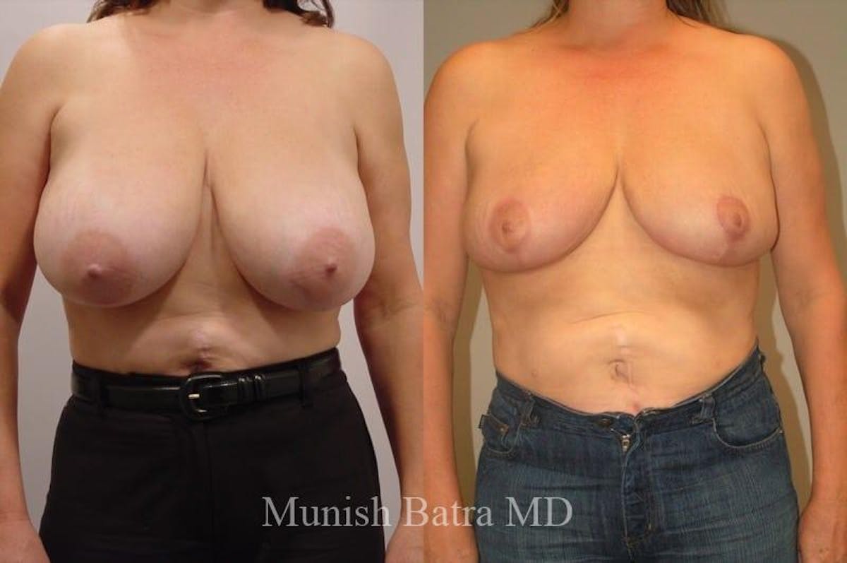 Breast Lift – Reduction Before & After Gallery - Patient 366717 - Image 1