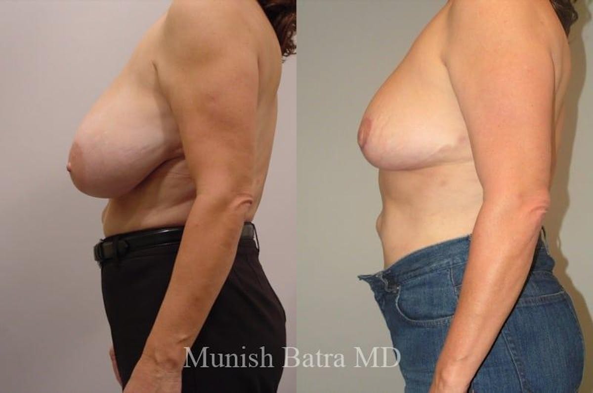 Breast Lift – Reduction Before & After Gallery - Patient 366717 - Image 2