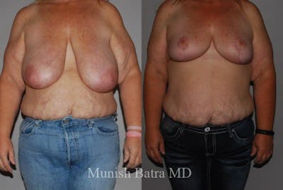 Breast Lift – Reduction Before & After Gallery - Patient 357968 - Image 1