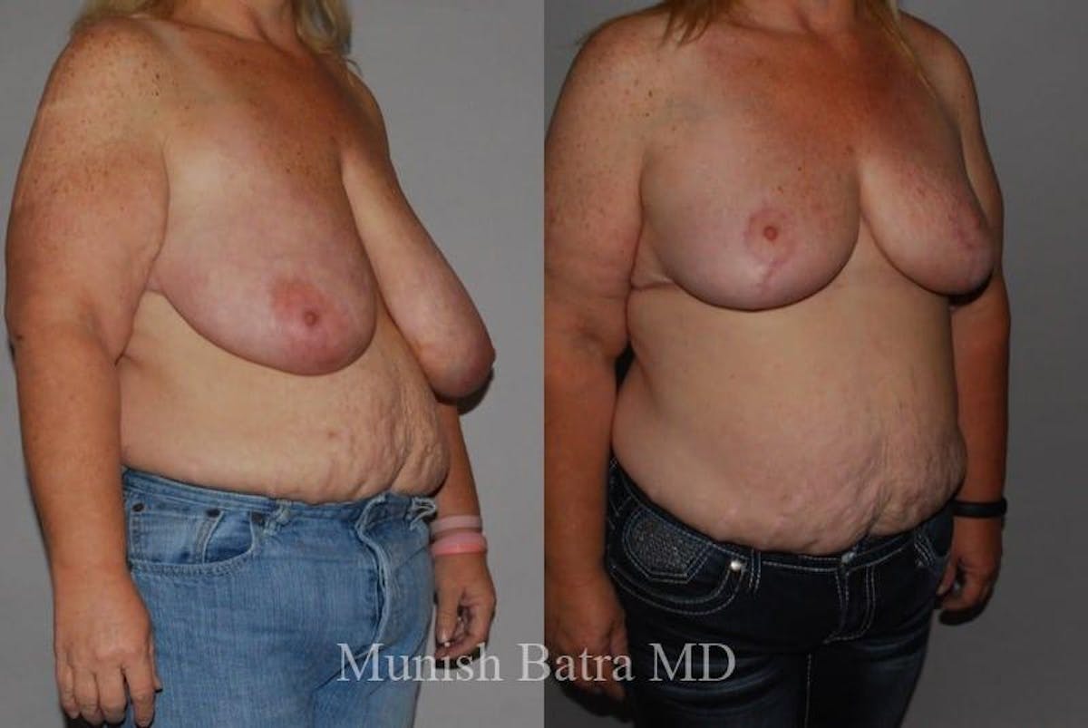 Breast Lift – Reduction Before & After Gallery - Patient 357968 - Image 2