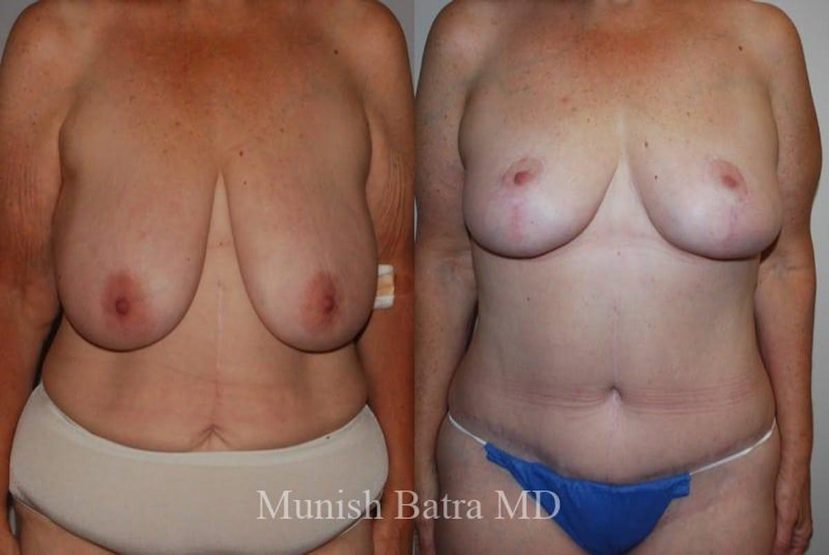 Breast Lift – Reduction Before & After Gallery - Patient 208700 - Image 1