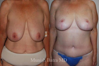 Breast Lift – Reduction Before & After Gallery - Patient 208700 - Image 1