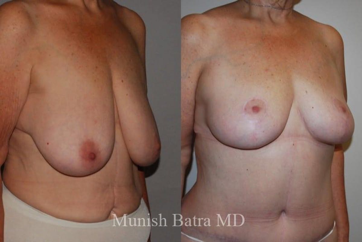 Breast Lift – Reduction Before & After Gallery - Patient 208700 - Image 2