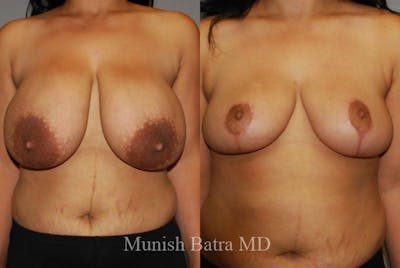 Breast Lift – Reduction Before & After Gallery - Patient 735011 - Image 1
