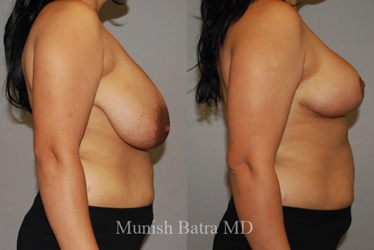 Breast Lift – Reduction Before & After Gallery - Patient 735011 - Image 2