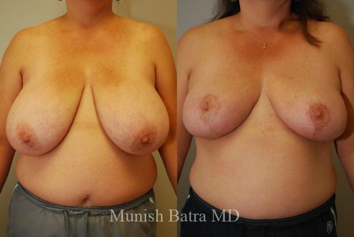 Breast Lift – Reduction Before & After Gallery - Patient 309840 - Image 1