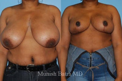 Breast Lift – Reduction Before & After Gallery - Patient 177646 - Image 1