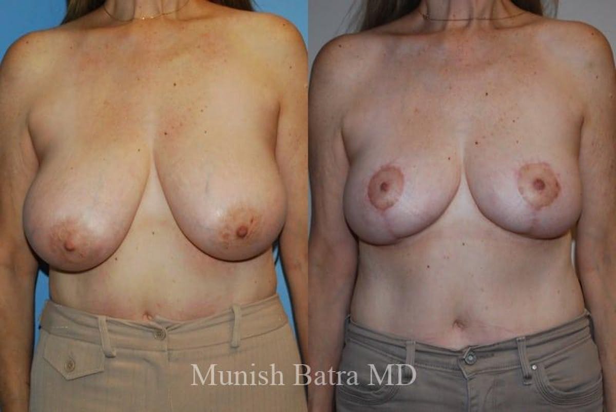 Breast Lift – Reduction Before & After Gallery - Patient 421365 - Image 1
