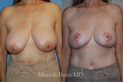 Breast Lift – Reduction Before & After Gallery - Patient 421365 - Image 1