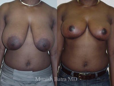 Breast Lift – Reduction Before & After Gallery - Patient 409578 - Image 1