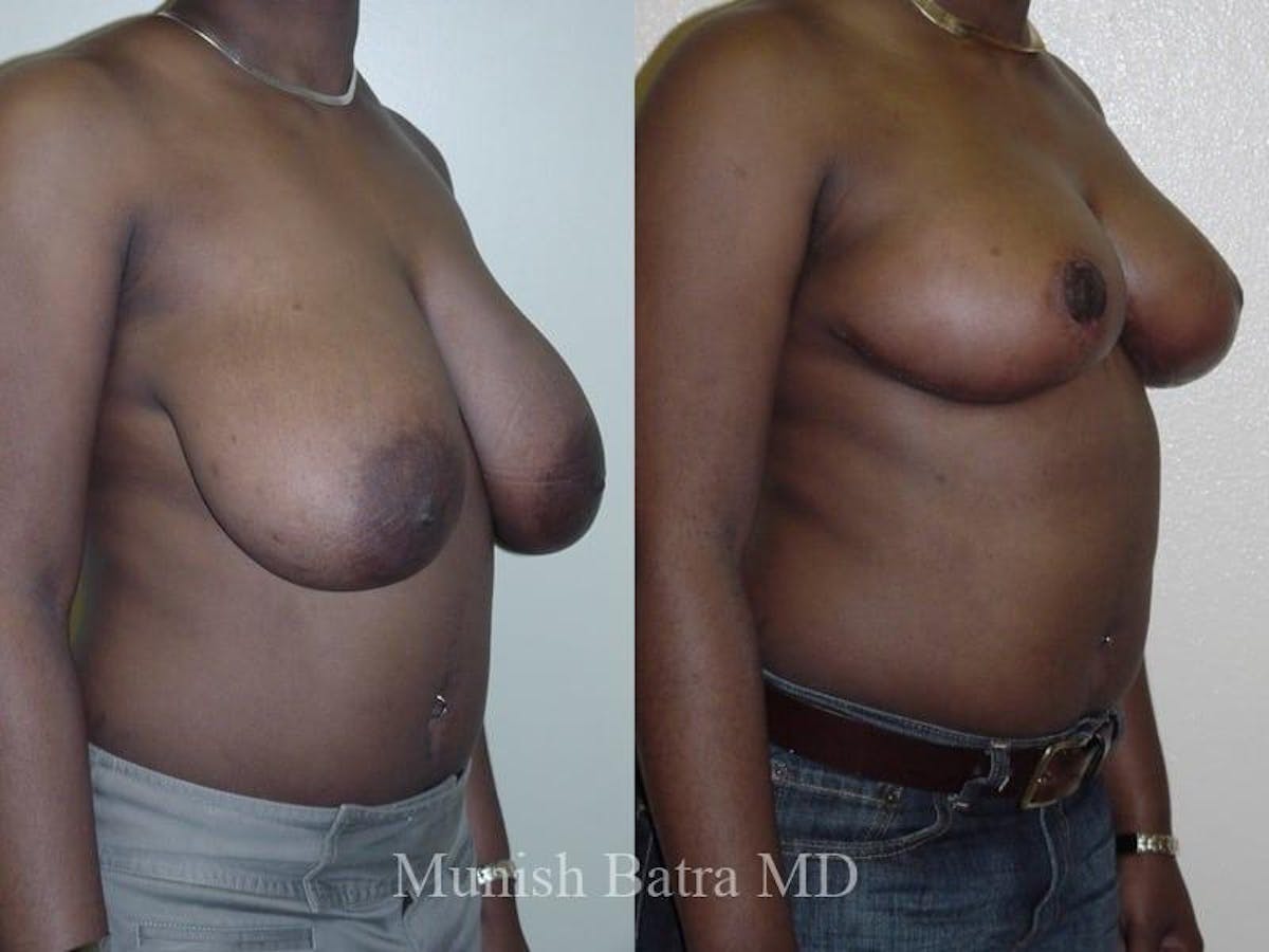 Breast Lift – Reduction Before & After Gallery - Patient 409578 - Image 2