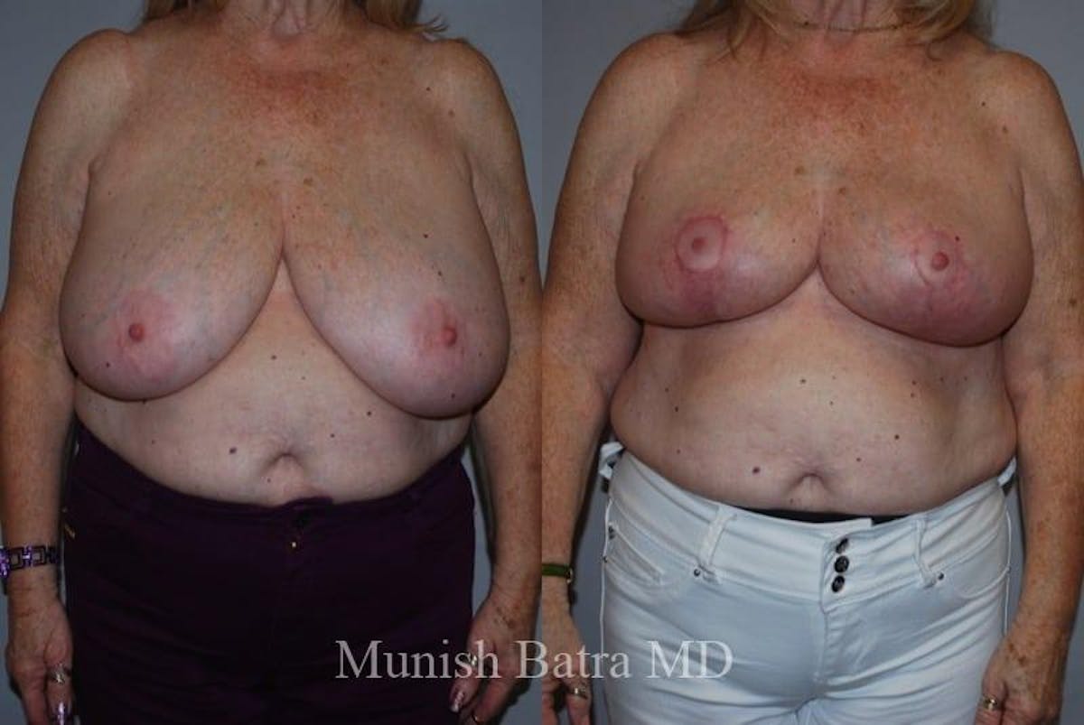 Breast Lift – Reduction Before & After Gallery - Patient 197556 - Image 1