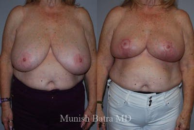 Breast Lift – Reduction Before & After Gallery - Patient 197556 - Image 1