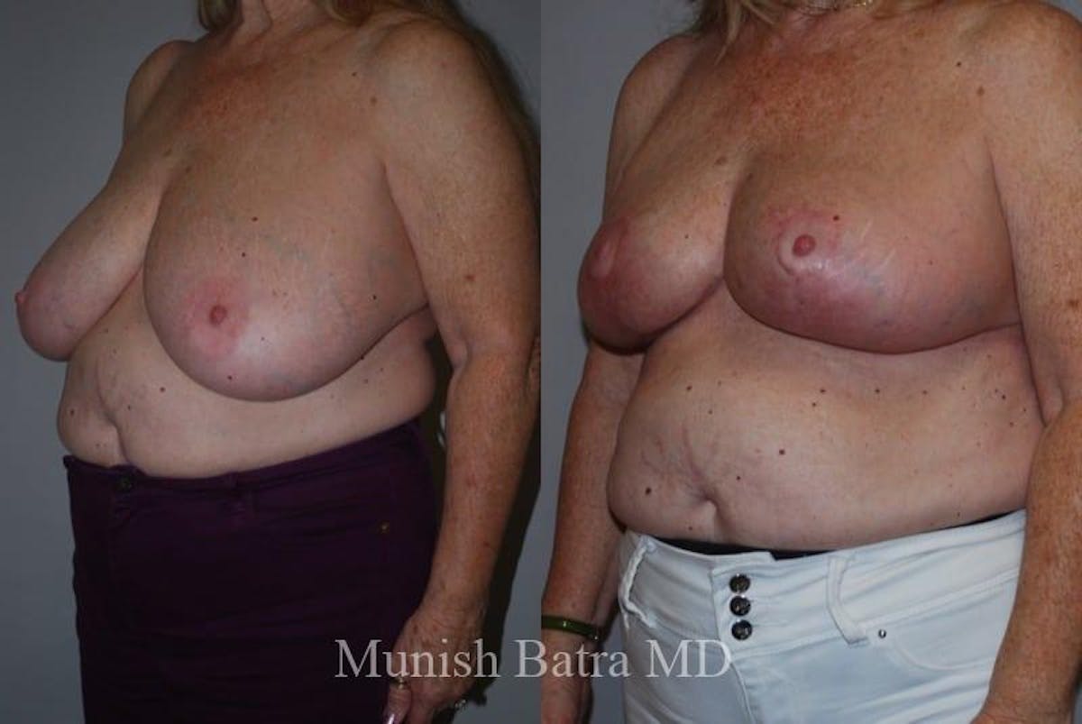 Breast Lift – Reduction Before & After Gallery - Patient 197556 - Image 2