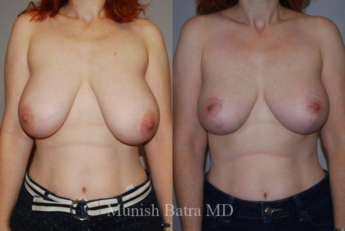 Breast Lift – Reduction Before & After Gallery - Patient 326399 - Image 1