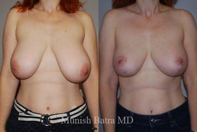 Breast Lift – Reduction Before & After Gallery - Patient 326399 - Image 1