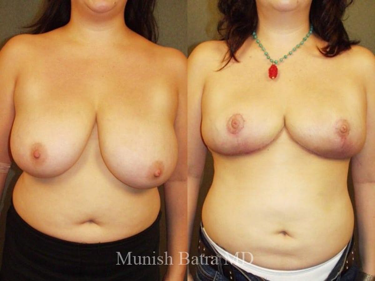 Breast Lift – Reduction Before & After Gallery - Patient 385657 - Image 1