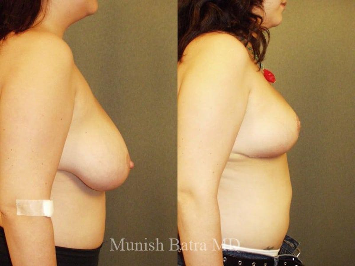 Breast Lift – Reduction Before & After Gallery - Patient 385657 - Image 2