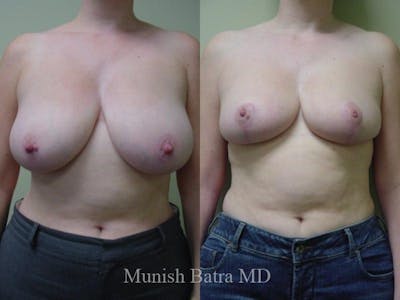 Breast Lift – Reduction Before & After Gallery - Patient 213994 - Image 1