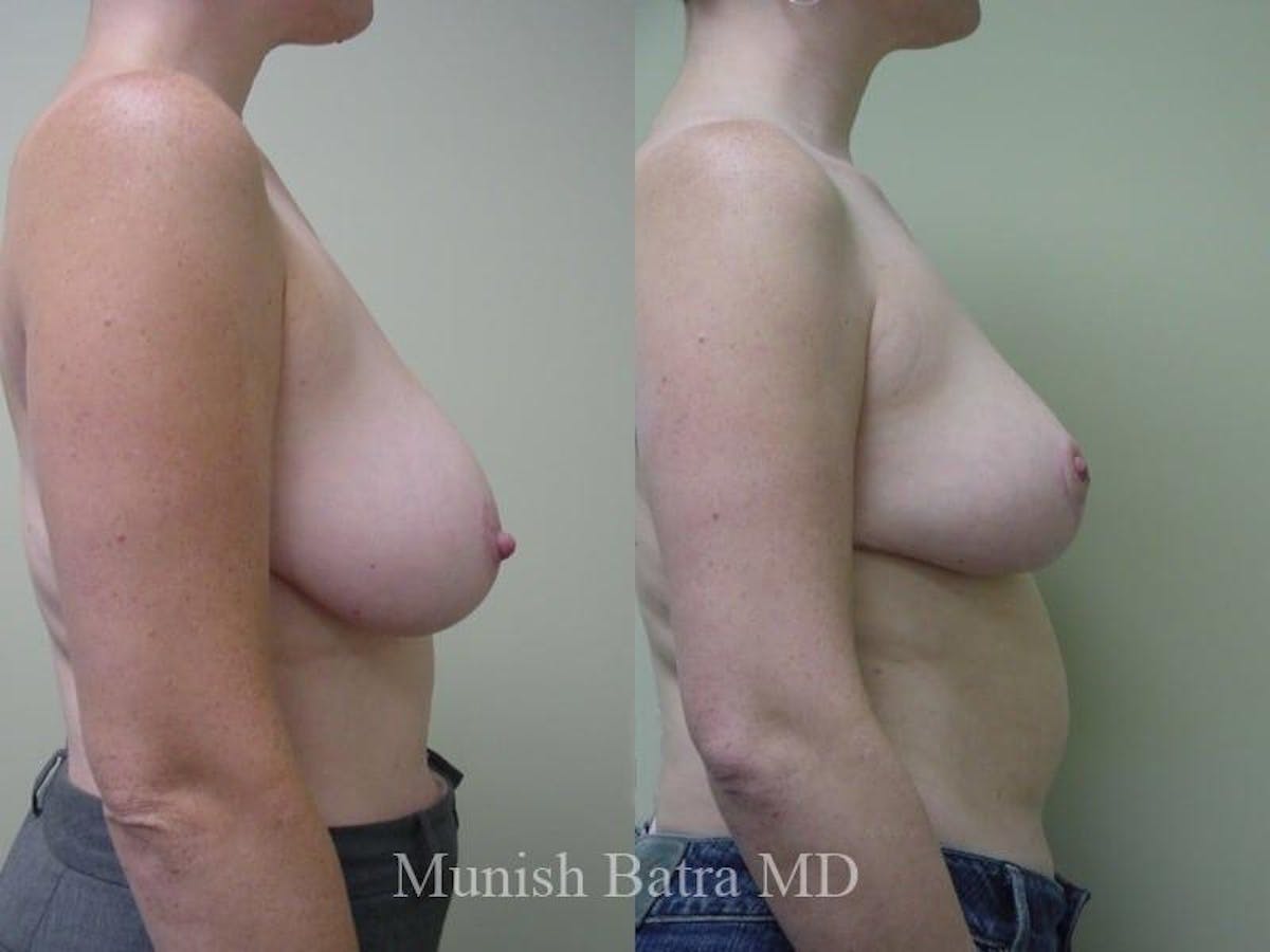 Breast Lift – Reduction Before & After Gallery - Patient 213994 - Image 2